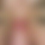 Furunkel. Solitärer, akut aufgetretener, seit 3 Tagen zunehmender, unscharf begrenzter, spontan s...