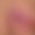 Abszess:  akuter, schmerzhafter Abszess.  
